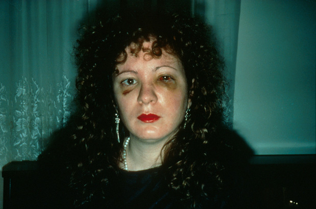 Nan Goldin one month after being battered by a boyfriend in 1984, self portrait