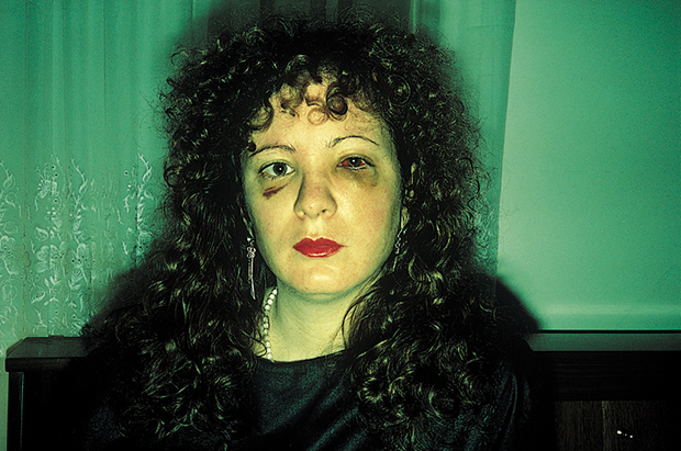 Nan one month after being battered (1984) by Nan Goldin. As reproduced in Body of Art